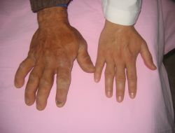 Akromegali hastalığına dikkat 