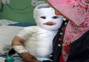 Süt kazanına düşen çocuk feci şekilde yandı